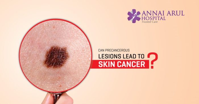 CAN PRECANCEROUS LESIONS LEAD TO SKIN CANCER? – Multispeciality ... Non cancerous and pre cancerous skin lesions