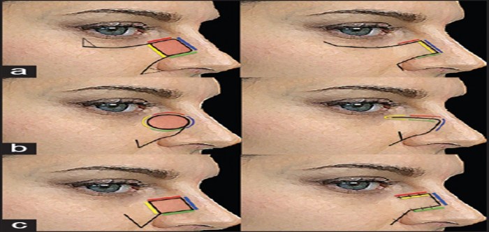 Surgical margin in skin cancer