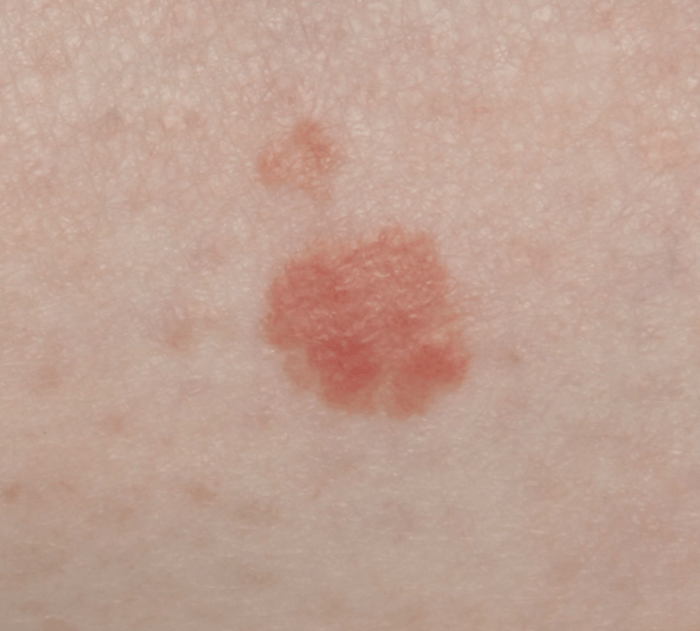 Non cancerous and pre cancerous skin lesions