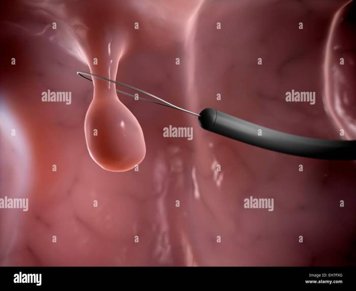Polyp removal hi-res stock photography and images - Alamy What happens if a polyp that is removed contains cancer