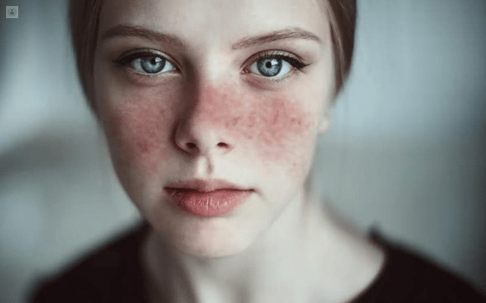 How lupus is diagnosed