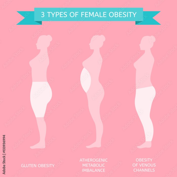3 types of obesity. Female figure in profile Stock Vector | Adobe Stock Different types of obesity