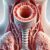 What is Tracheal Stenosis? A Comprehensive Guide