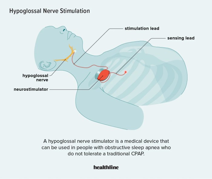 Implant for sleep apnea
