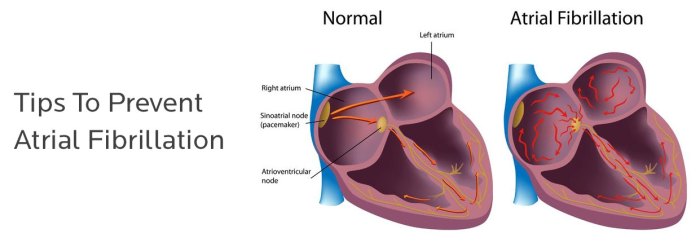 Atrial fibrillation drugs to avoid