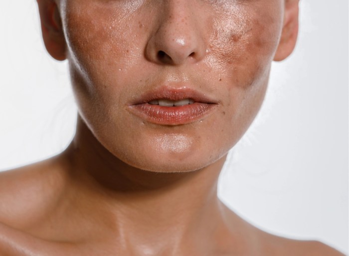 Causes of Dark Spots Unveiling the Secrets