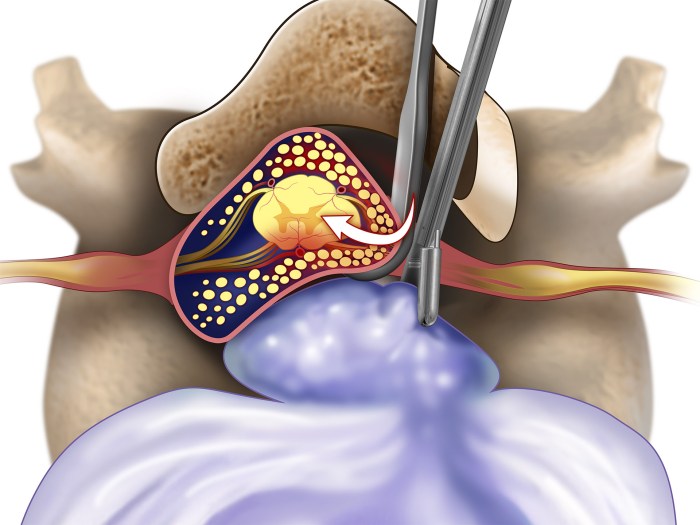 Herniated disc surgery overview