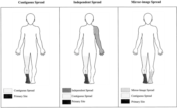 Complex Regional Pain Syndrome - Monarch Pain Management What is reflex sympathetic dystrophy syndrome rsd