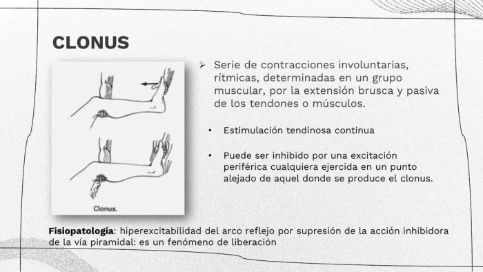 Clonus Causes, Diagnosis, and Treatment