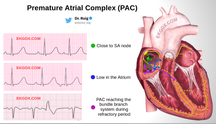 Premature atrial complexes pacs