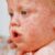 Measles Cases Rise Worldwide A Global Crisis