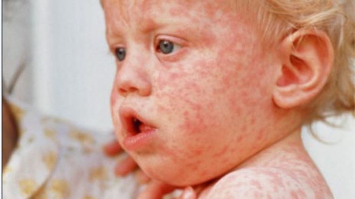 Measles Cases Rise Worldwide A Global Crisis
