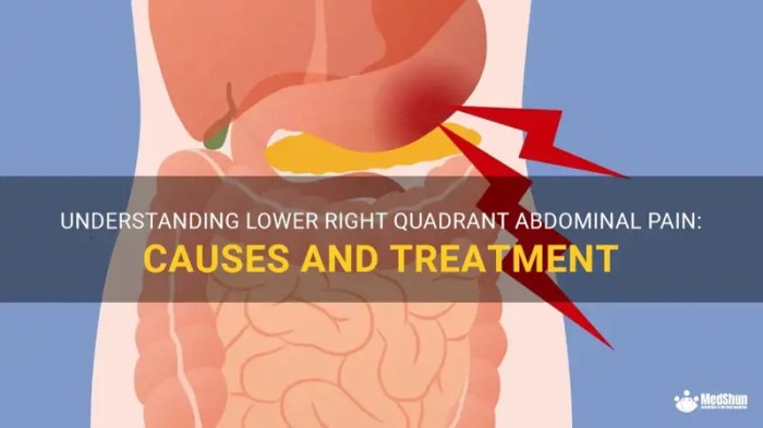 Understanding Lower Right Quadrant Abdominal Pain: Causes And Treatment ... Lower right abdomen pain