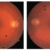 Living with Macular Telangiectasia Type 2