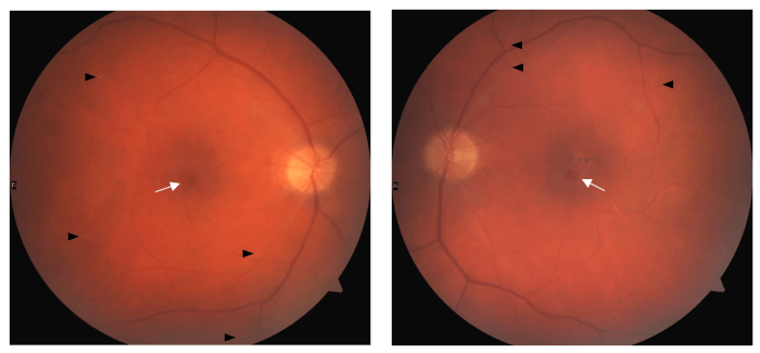 Living with Macular Telangiectasia Type 2