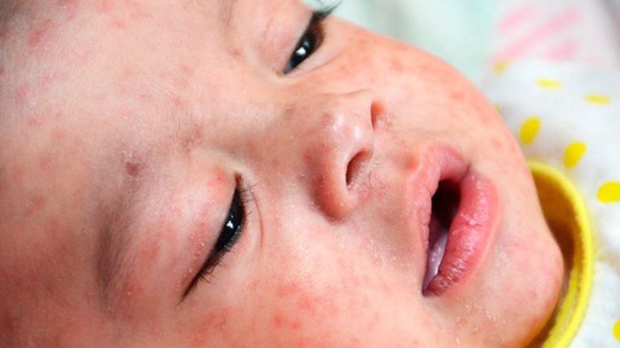 Measles cases rise worldwide