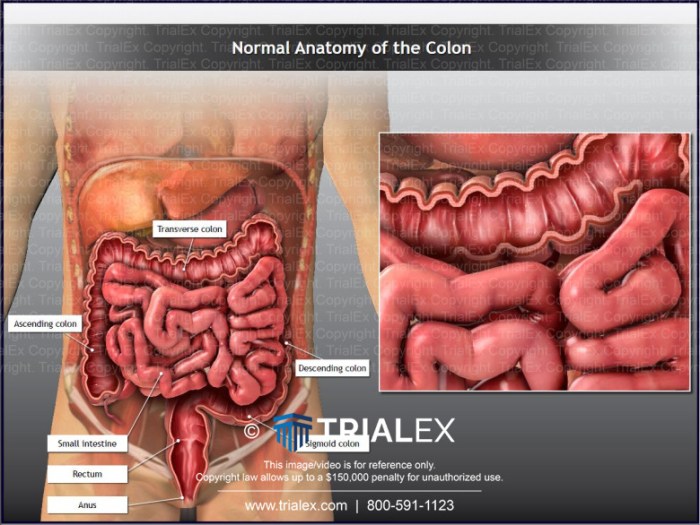Colon cancer causes risk factors