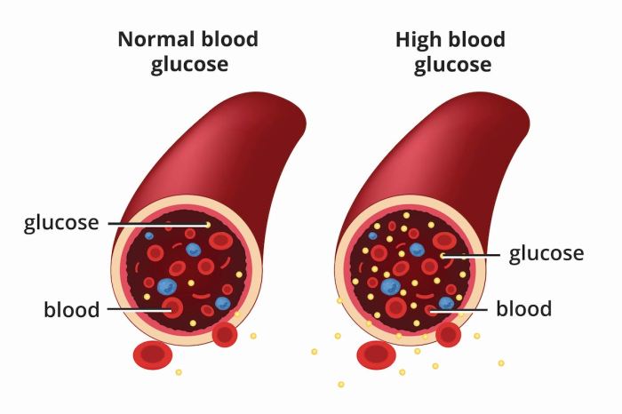 Diabetes and colon cancer