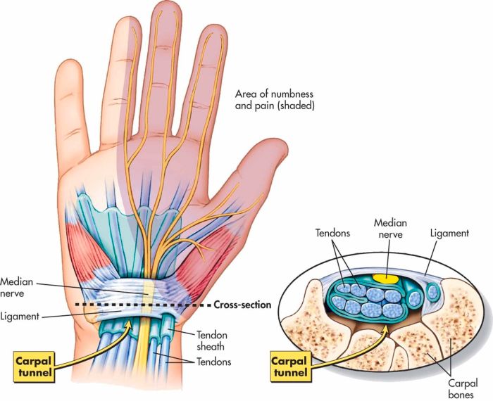 Carpal Tunnel Syndrome Carpal tunnel risk of stiff heart syndrome