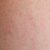 Rash on Buttocks Treatment A Comprehensive Guide