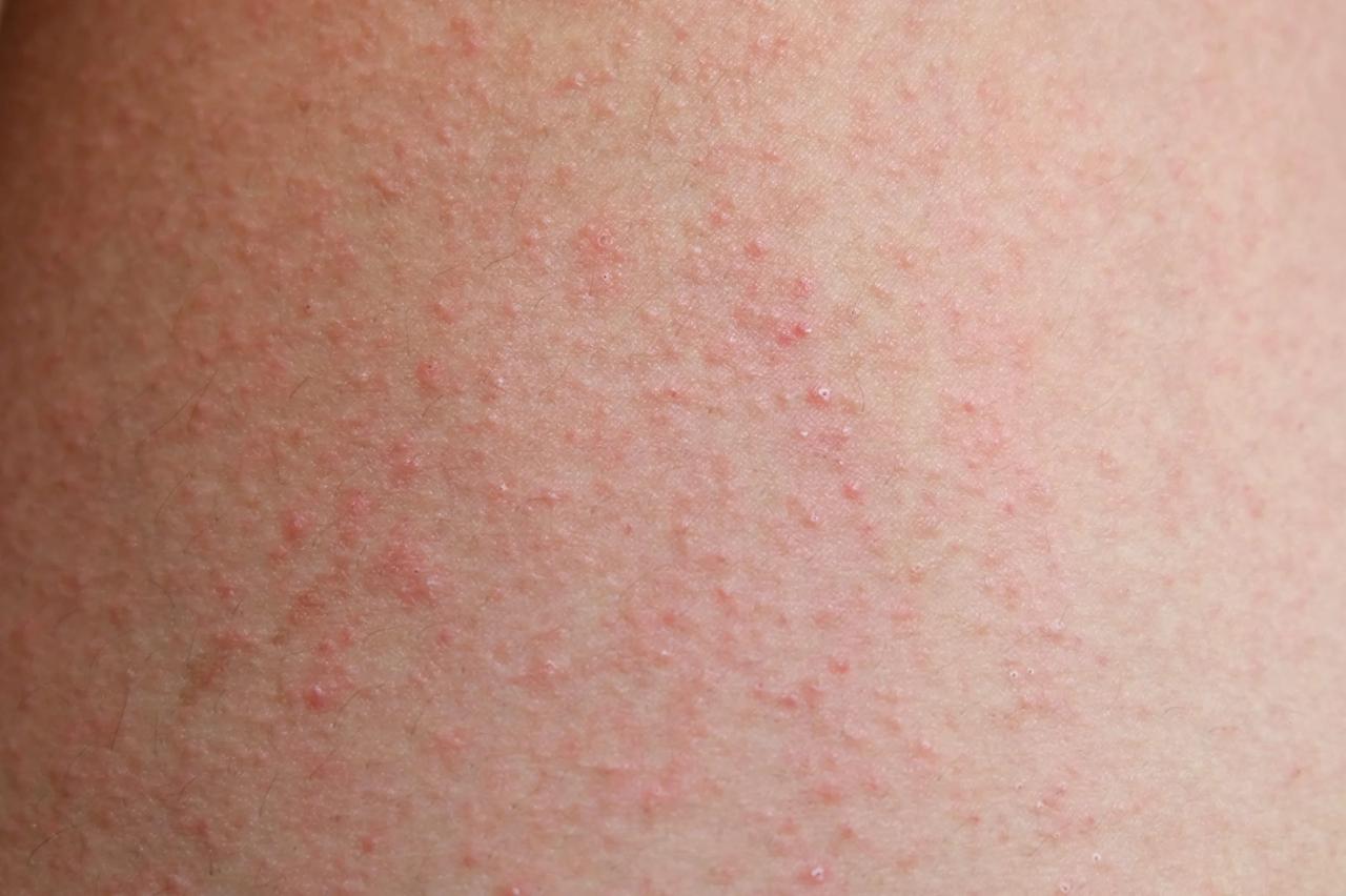 Rash on buttocks treatment