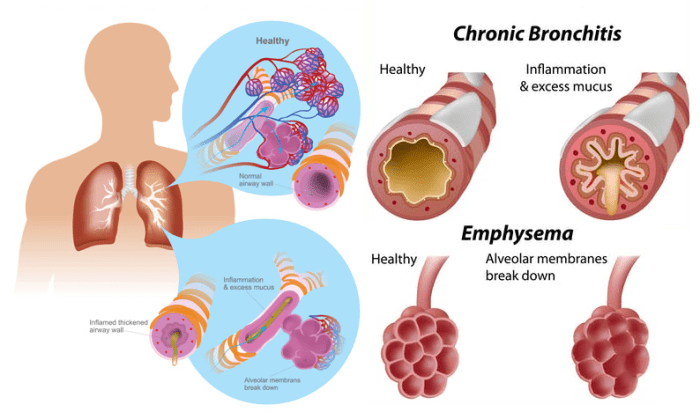 KLE Hospital Copd and herbal remedies