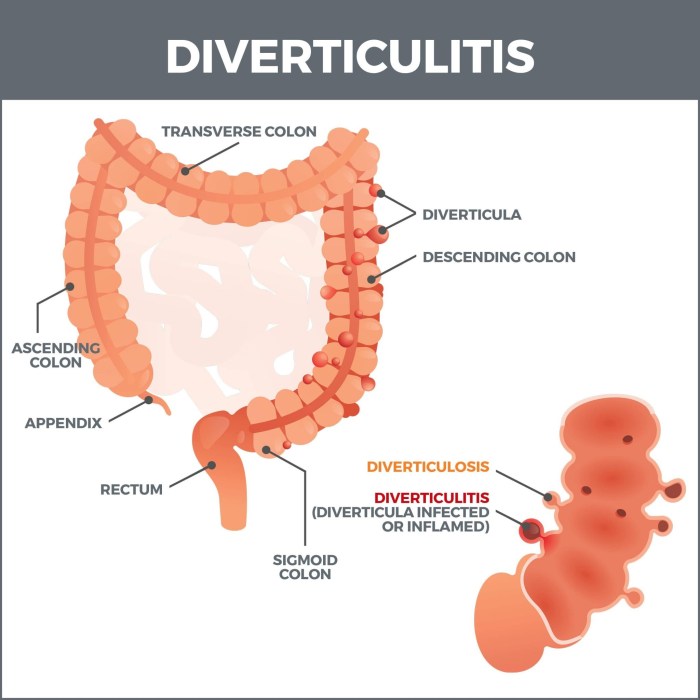 Diverticulitis: Causes, symptoms, and treatments Diverticulitis signs symptoms and complications