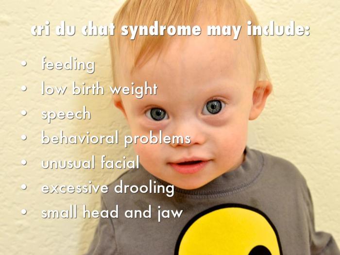 Cri Du Chat Syndrome Cri du chat syndrome
