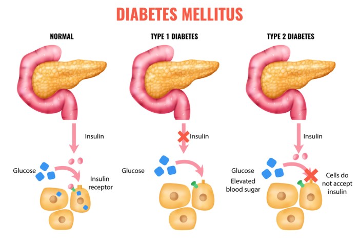 Diabetes Basics | Diabetes | CDC Diabetes and liver disease