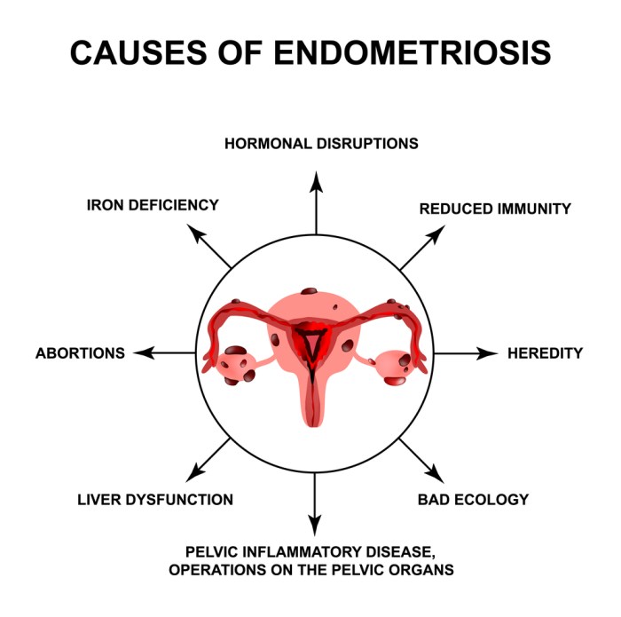Bladder Problems in Endometriosis A Deep Dive