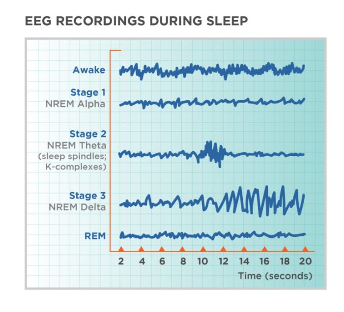 Lack of Sleep and Migraine A Deep Dive