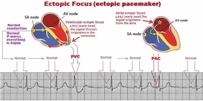Living with a Pacemaker A Comprehensive Guide