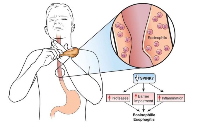 Eosinophilic esophagitis signs symptoms