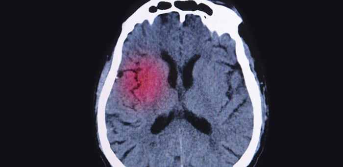 Migraine trigger food list