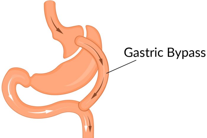 Gastric Bypass Surgery: Recovery Mash and bariatric surgery