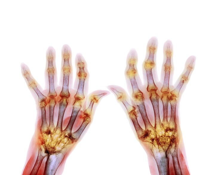 Rheumatoid Arthritis Effects Body Systems Impact