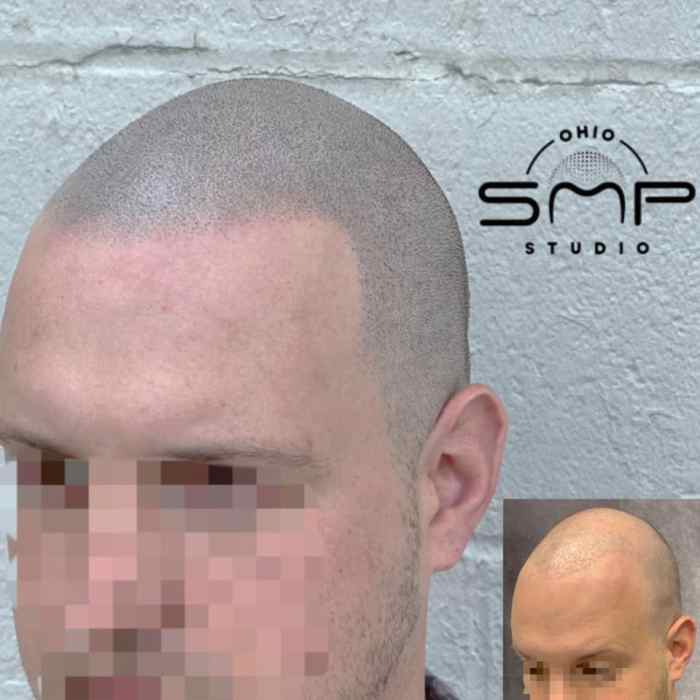 What causes hair loss