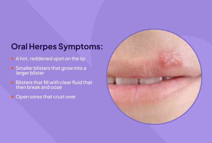 Herpes causes risk factors