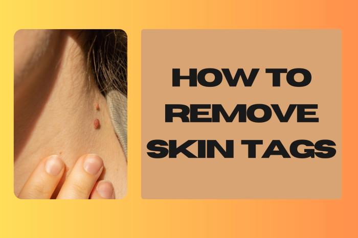 How to prevent skin tags