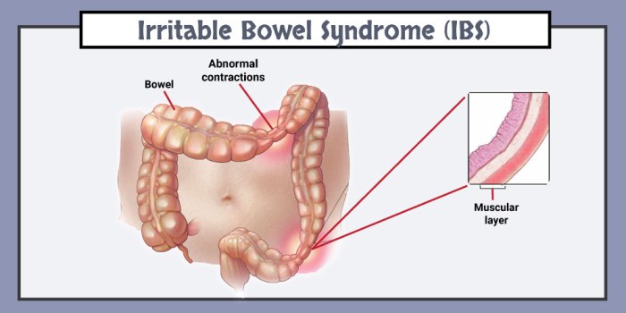 Tortuous colon and ibs