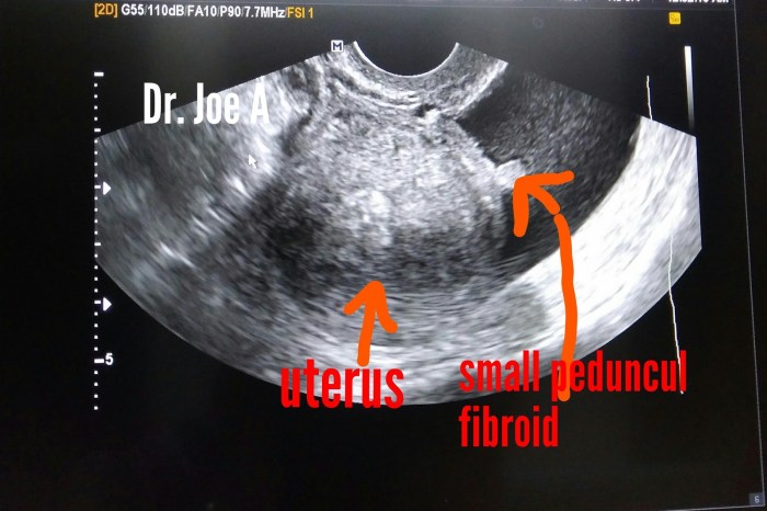 How fibroid pain is treated