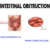 Distal Intestinal Obstruction Syndrome A Deep Dive