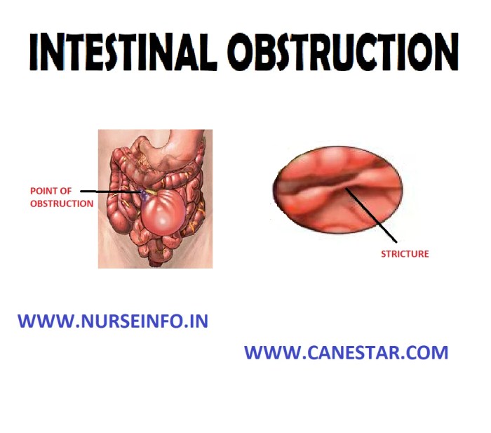 Distal intestinal obstruction syndrome