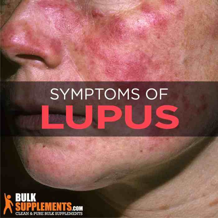 Lupus Causes, Symptoms and Treatment Information | Piedmont Healthcare Lupus Causes, Symptoms and Treatment Information | Piedmont Healthcare