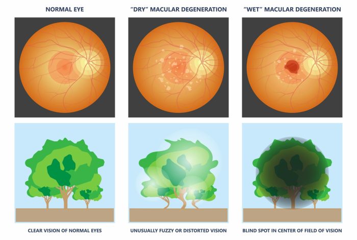 Dry Macular Degeneration Macular degeneration coping support and living well