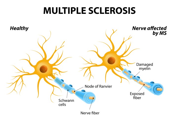 Dysesthesia and multiple sclerosis