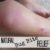 How to Treat Bug Bites A Comprehensive Guide