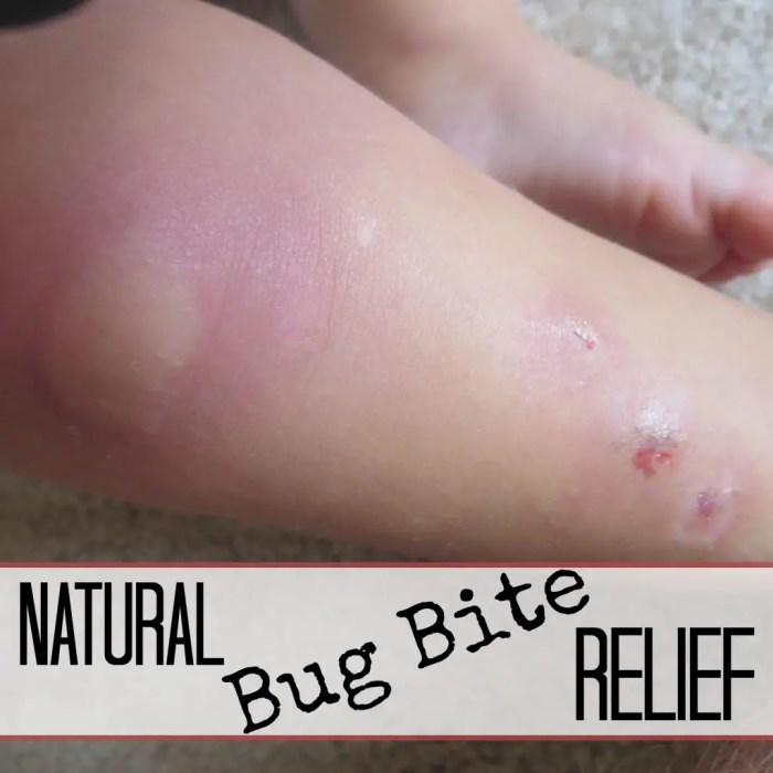 How to treat bug bites