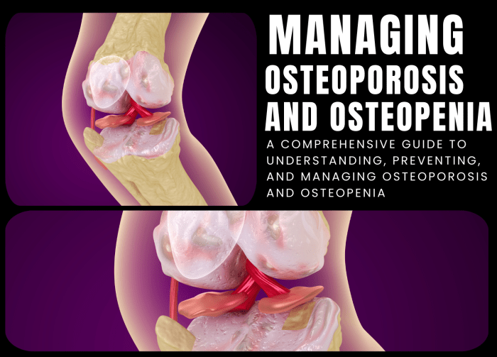 How to Prevent and Manage Osteopenia A Comprehensive Guide