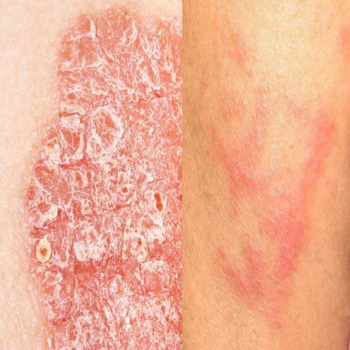 Eczema and sun exposure